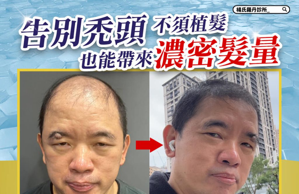 複合式生髮_外泌體育髮