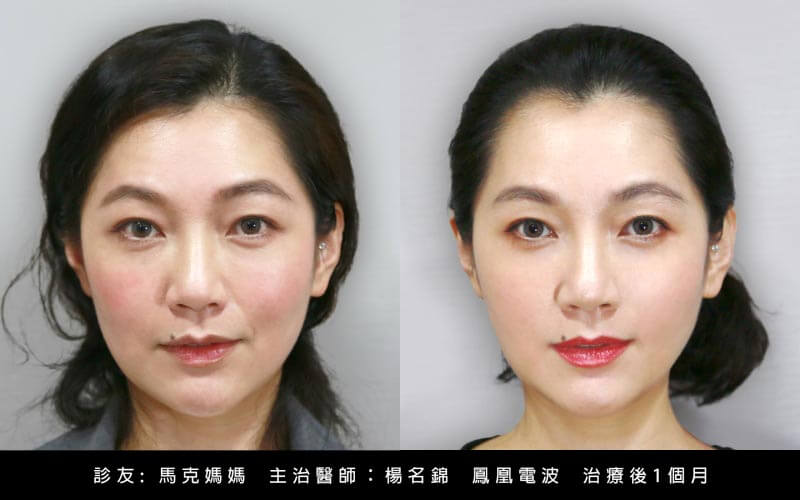 馬克媽媽鳳凰電波_術後1個月