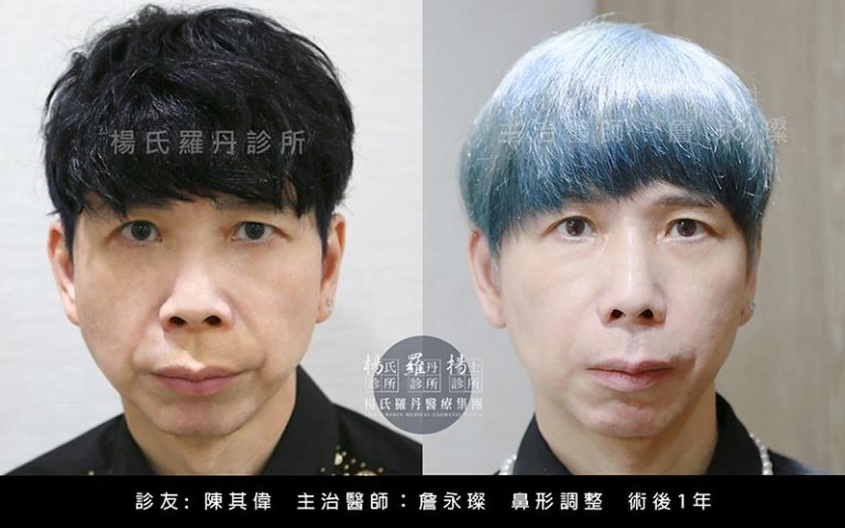 鼻形調整術後1年