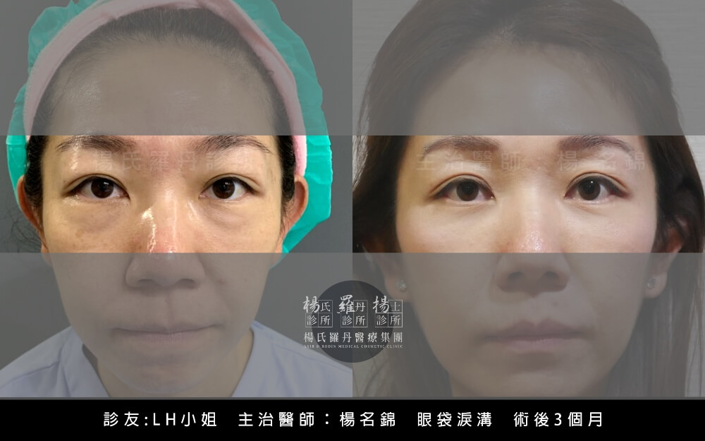 眼袋淚溝術後3個月