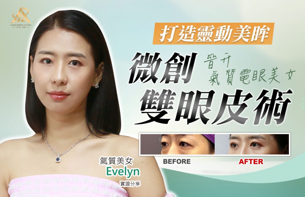 雙眼皮手術_雙眼皮_割雙眼皮_楊氏羅丹