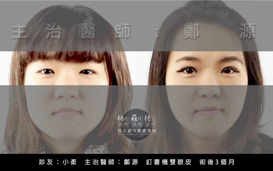 釘書機雙眼皮術後3個月