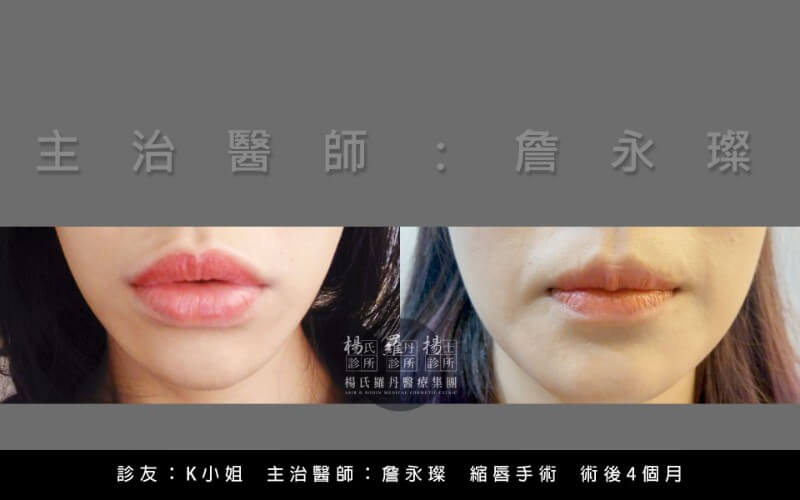 縮唇手術術後4個月