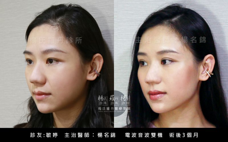 電波音波_楊氏羅丹_醫美療程